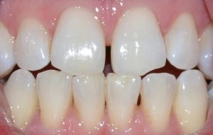  After Tooth Whitening