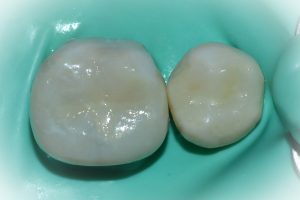  Modern tooth coloured fillings